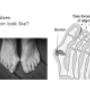 Bunions (Hallux Abducto Valgus)