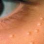 Skin-Tag Removal
