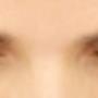 Latisse