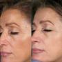 PRP Treatment