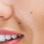 Skin Lesion