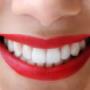 Teeth Whitening