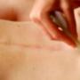 gua-sha