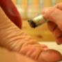 Moxibustion