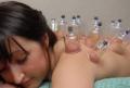 Cupping