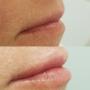 0.5 ml - Lip Filler