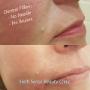 1ml - Dermal Filler
