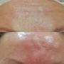 Dermal Filler - Forehead Static