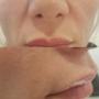 Dermal Filler - Nasolabial Folds