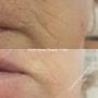 Dermal Filler - Superficial Lines