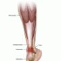 achillies tendonitis