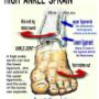 ankle sprain