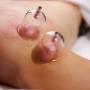 cupping