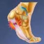 plantar fasciitis