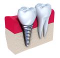dental-implants-dublin