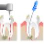 Root Canal Treatment