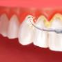 Periodontal Treatment