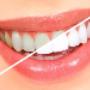 Teeth Whitening