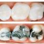 Fillings