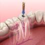 Root Canal Treatment