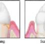 Gum Treatment