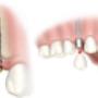 Dental Implant