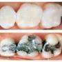 Regular & White Fillings