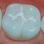 Fissure Sealants