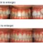 Before and After