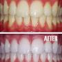 laser teeth whitening