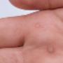 Warts / Verruca