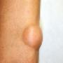 Lipoma