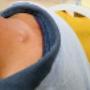 Sebaceous Cysts