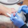 Ingrown Toe Nails