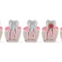 Root Canal Treatment