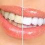 Tooth Whitening