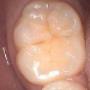 Fissure Sealants