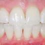 Gum Disease Treatment