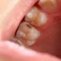 White & Amalgam Fillings