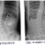 Scoliosis Treatment Ireland