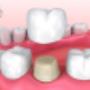 CROWNS