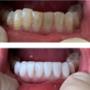 Composite veneers