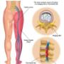 LOW BACK PAIN/ SLIPPED DISC & CHIROPRACTIC
