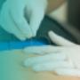 Dry Needling