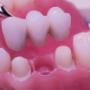 Dental Bridges