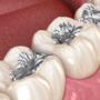 Dental Fillings