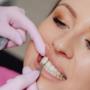 Dental Veneers