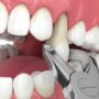 Tooth Extraction