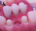 Dental-Bridges