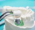Dental-Crowns